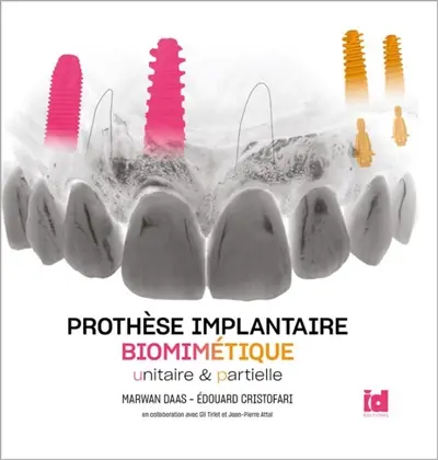 Prothèse implantaire biomimétique : unitaire & partielle