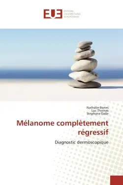 Mélanome complètement régressif : Diagnostic dermoscopique
