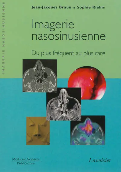 Imagerie nasosinusienne : du plus fréquent au plus rare